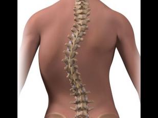 Dania suffers from a curved spine