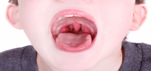 طفل يعاني من التهاب لوزتيه بشكل متكرر